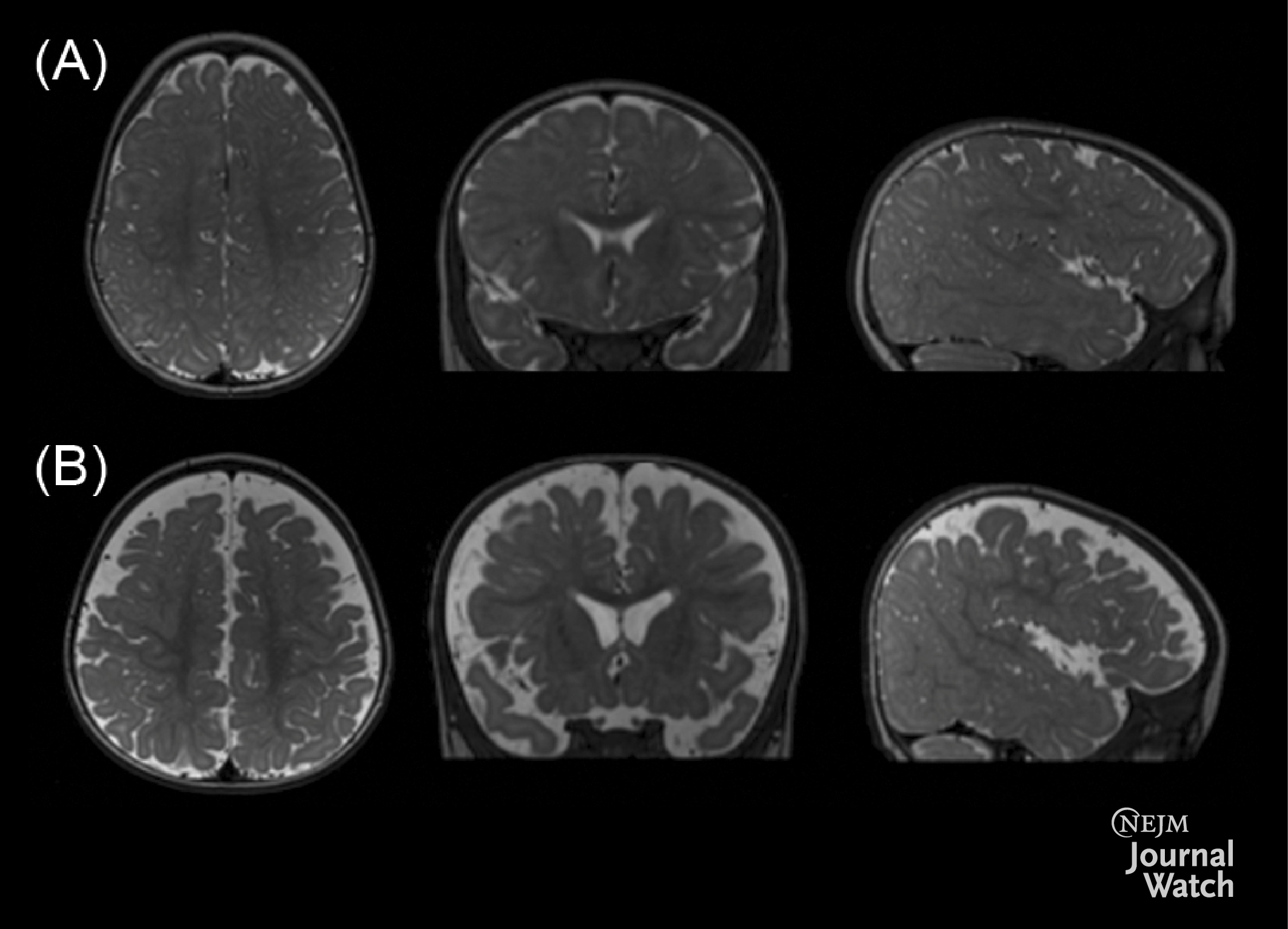 A Brain Marker for ASD in Very Young Children?
